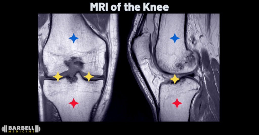 right knee sagittal and coronal MRI 